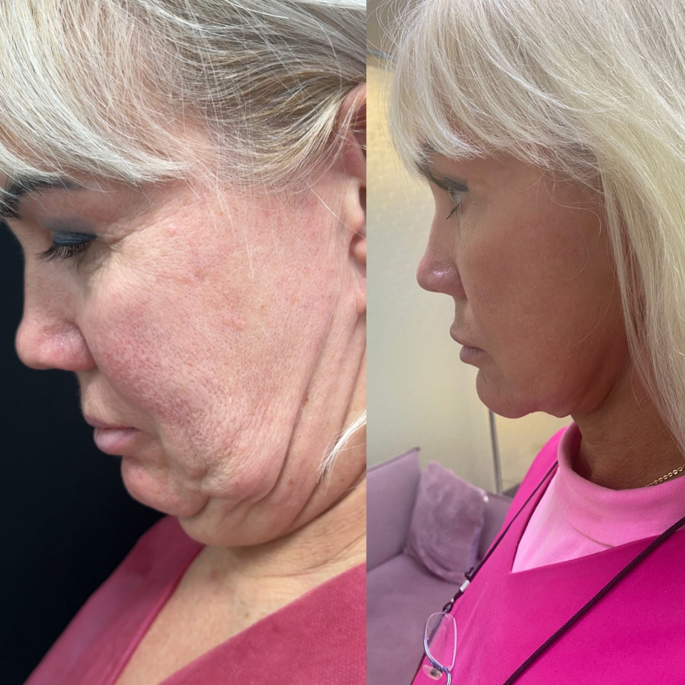 Фейслифтинг . Фото до и после , фотография 4