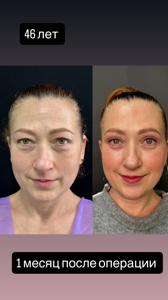 Пластика верхних и нижних век , фотография 1