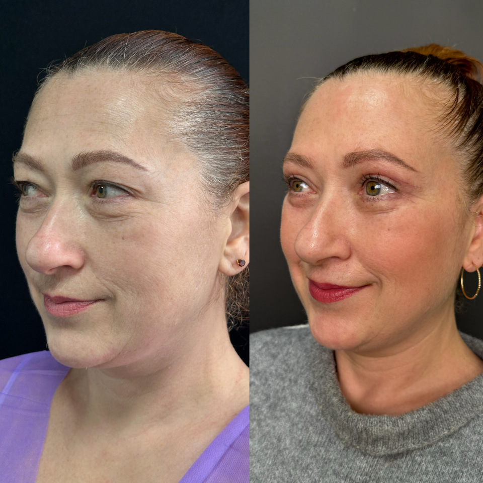 Пластика верхних и нижних век , фотография 2