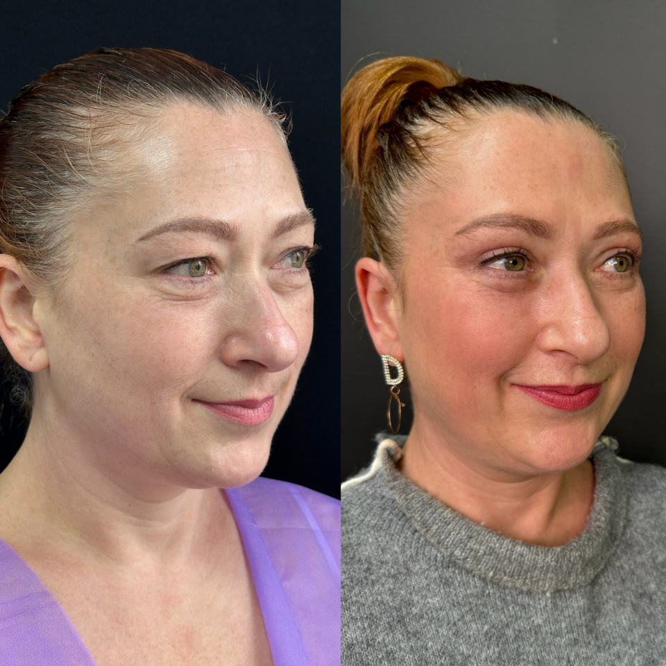 Пластика верхних и нижних век , фотография 3