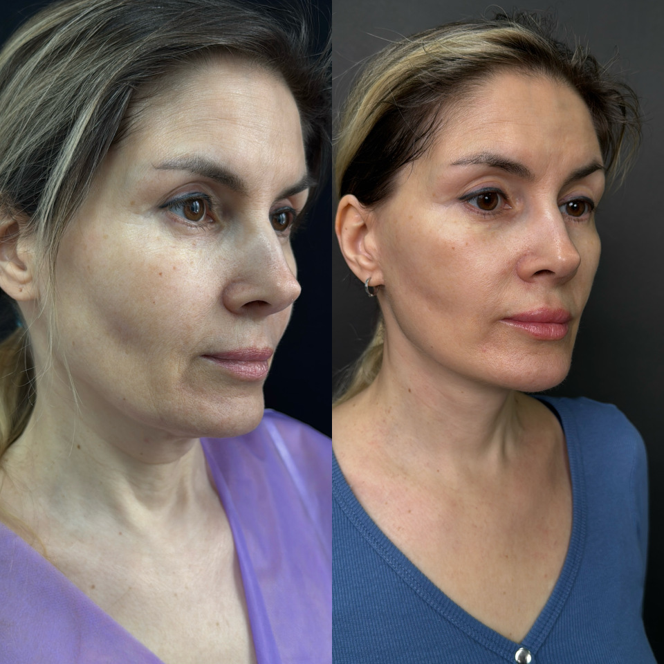 Подтяжка лица . Отдаленный результат. Фото до после , фотография 1