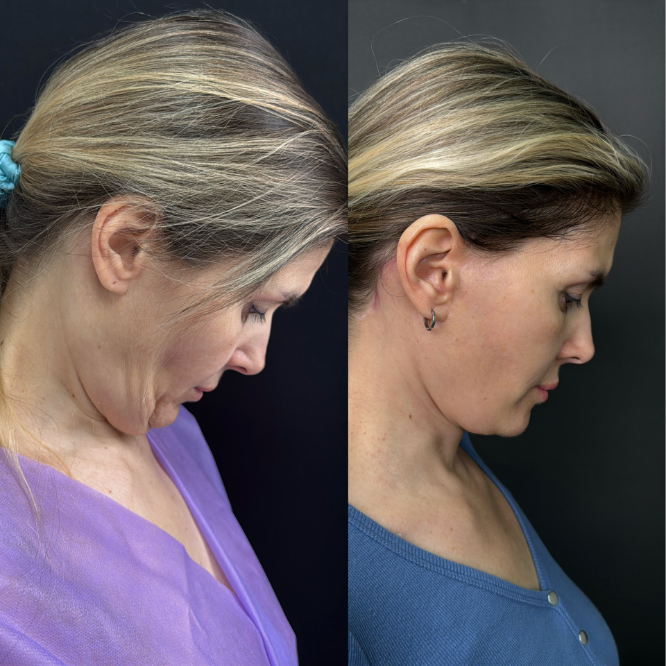 Подтяжка лица . Отдаленный результат. Фото до после , фотография 2