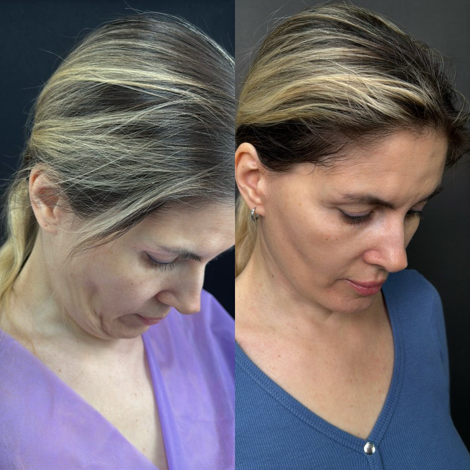 Подтяжка лица . Отдаленный результат. Фото до после , фотография 3