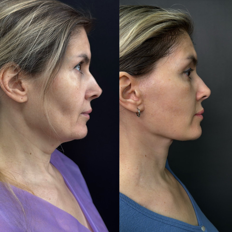 Подтяжка лица . Отдаленный результат. Фото до после , фотография 4