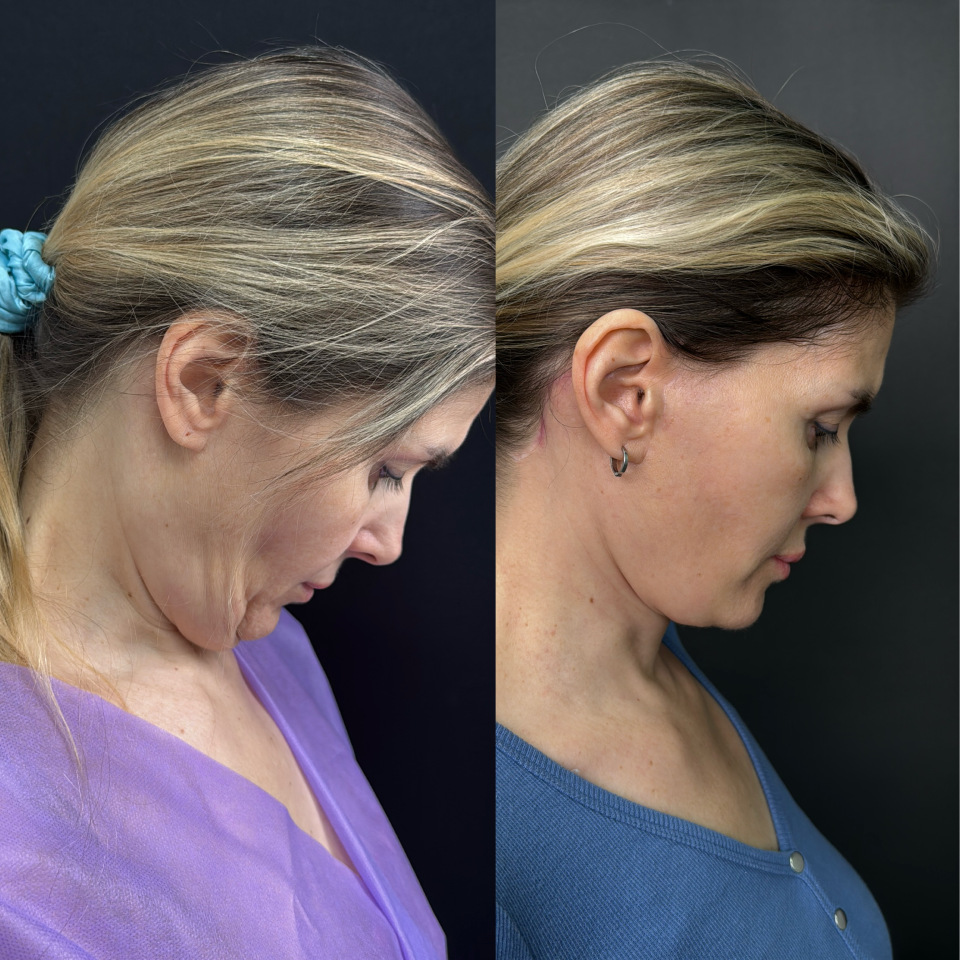 Подтяжка лица . Отдаленный результат. Фото до после , фотография 5
