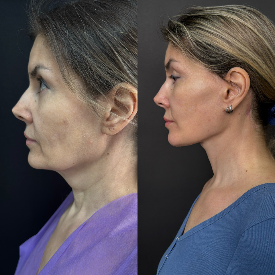 Подтяжка лица . Отдаленный результат. Фото до после , фотография 6
