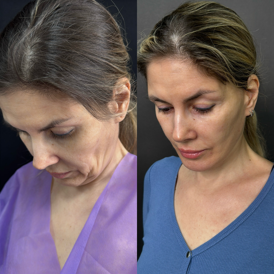 Подтяжка лица . Отдаленный результат. Фото до после , фотография 7
