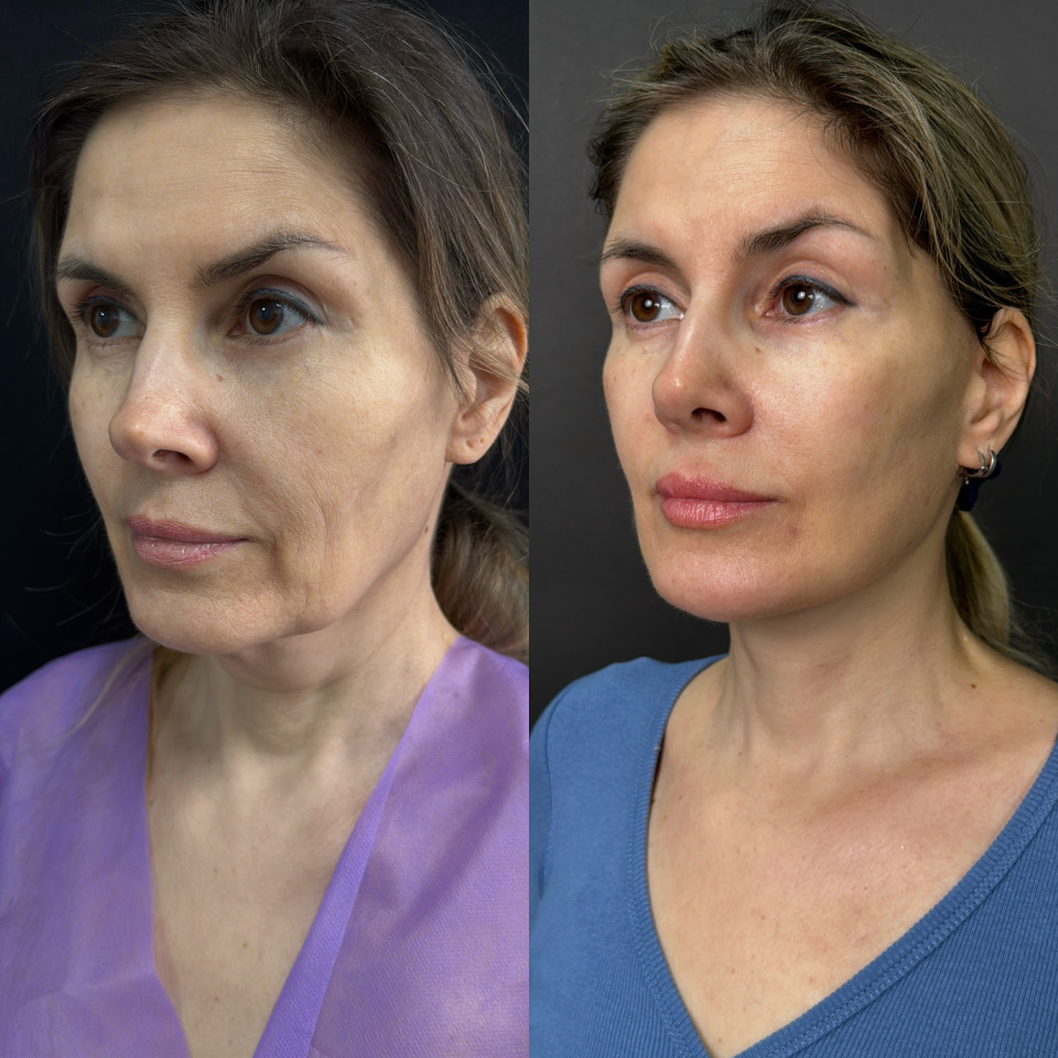 Подтяжка лица . Отдаленный результат. Фото до после , фотография 9