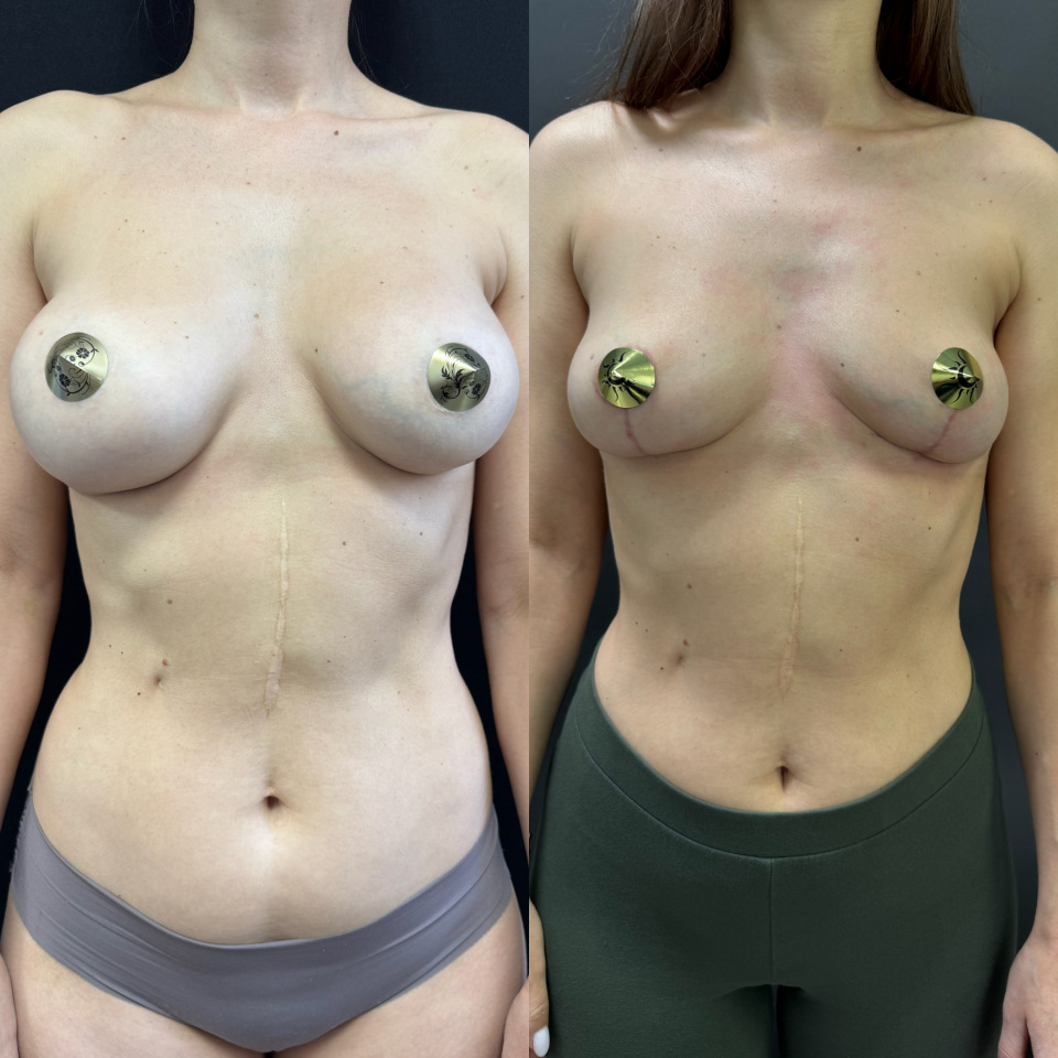 Удаление имплантов с подтяжкой. Фото до и после , фотография 1