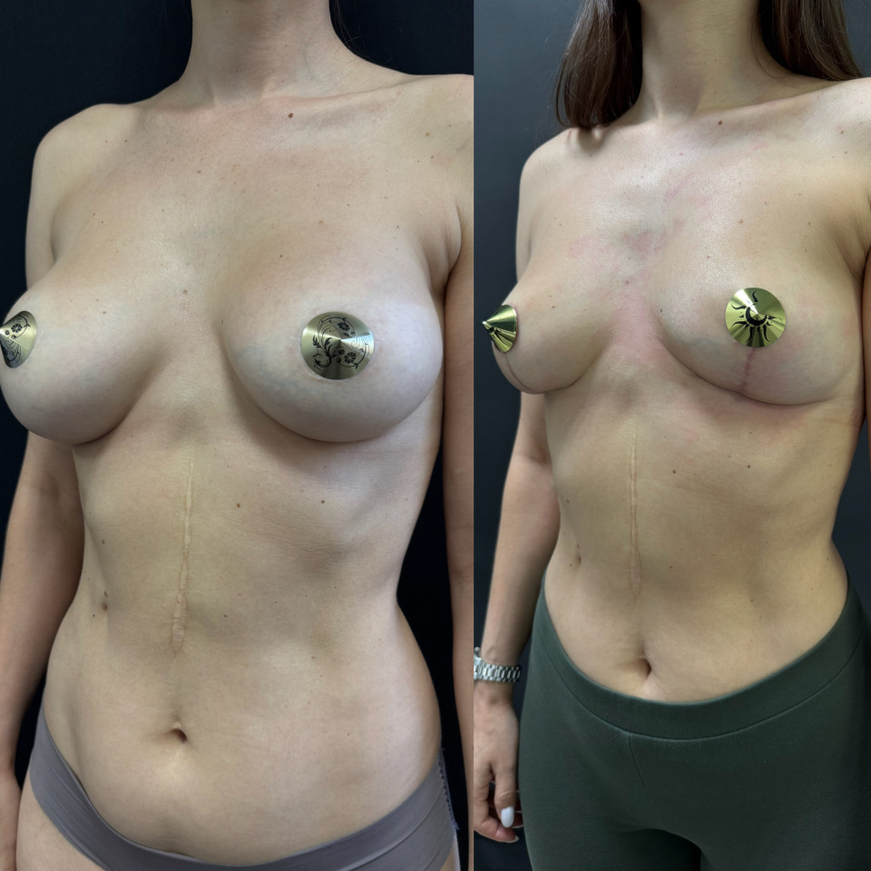 Удаление имплантов с подтяжкой. Фото до и после , фотография 2