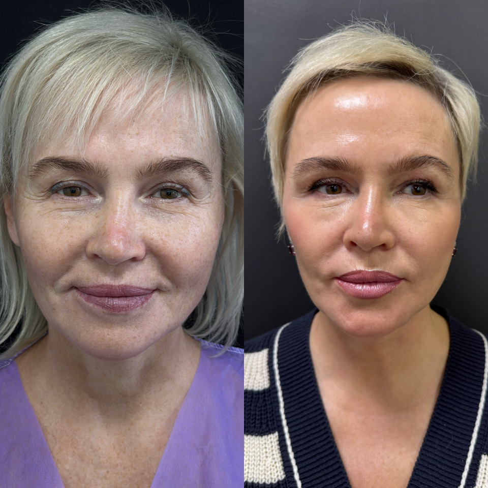 Подтяжка лица и шеи . Фото до и после , фотография 1