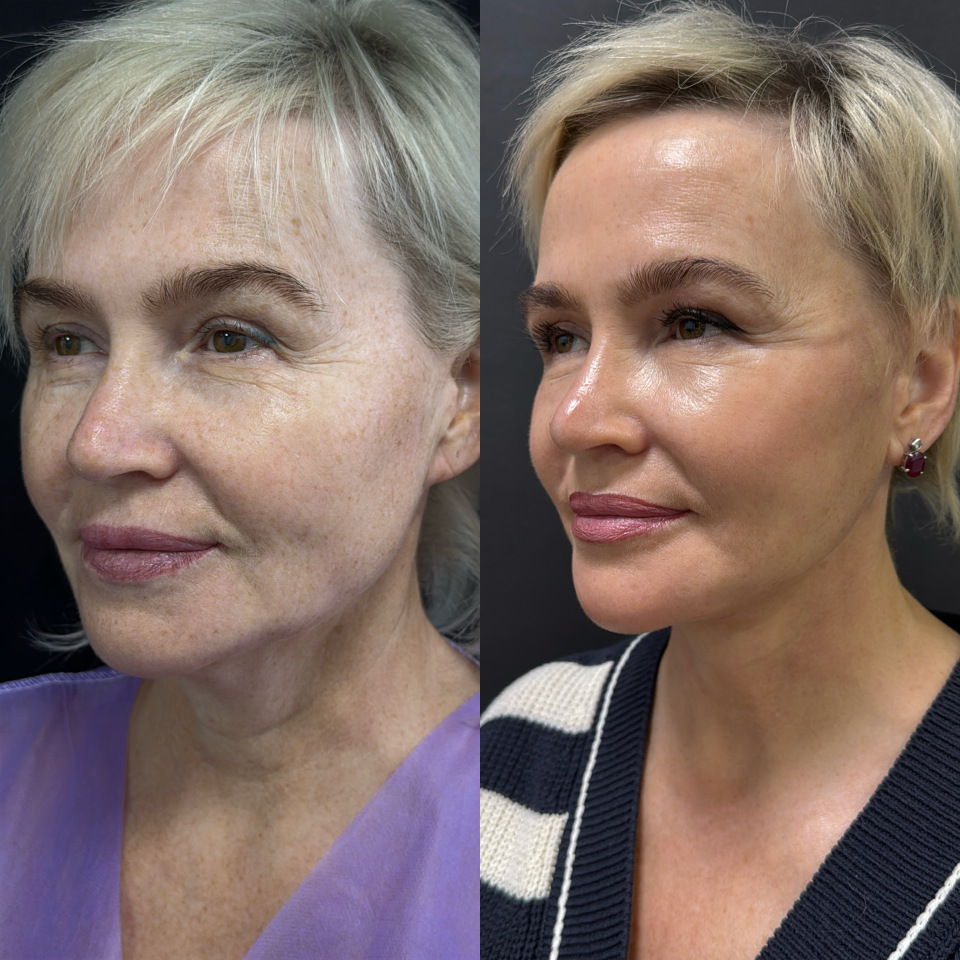 Подтяжка лица и шеи . Фото до и после , фотография 2