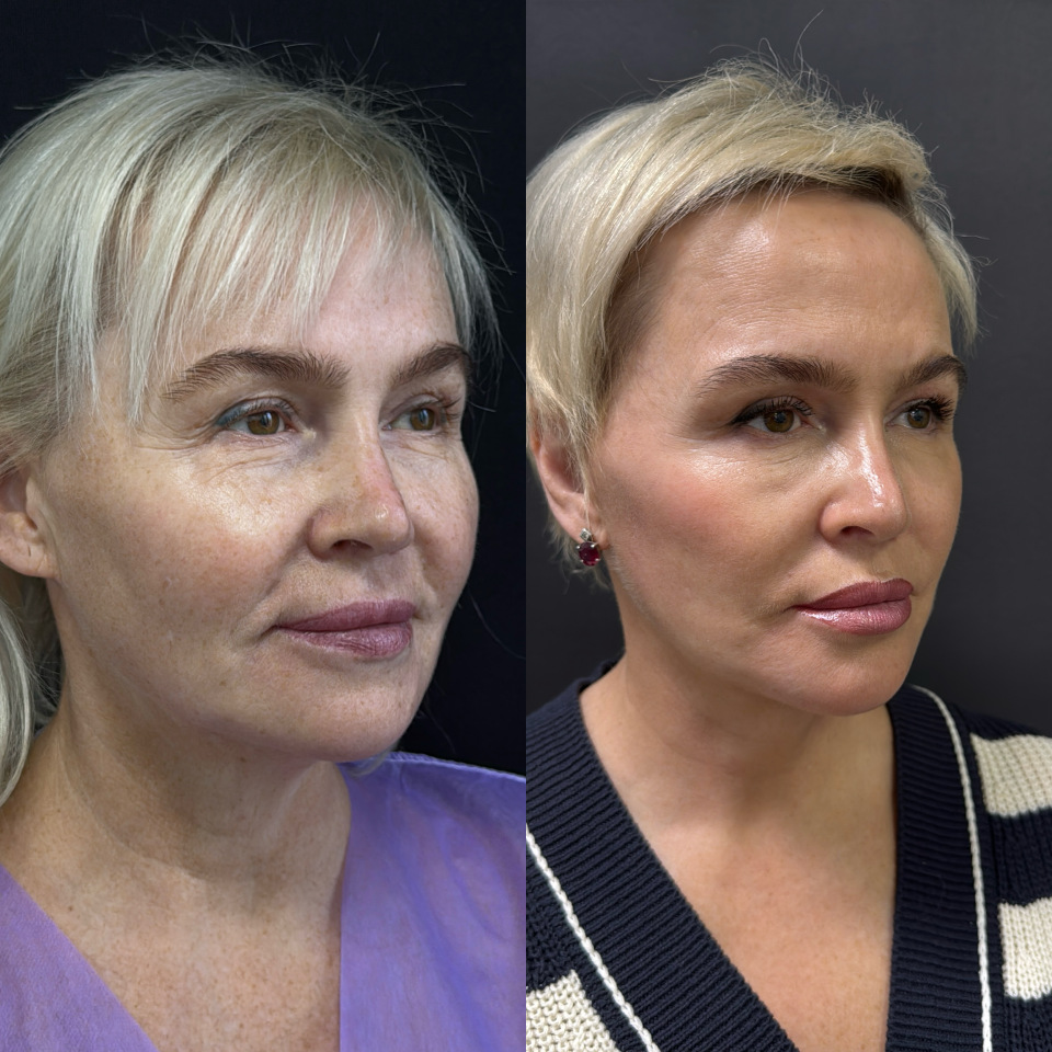 Подтяжка лица и шеи . Фото до и после , фотография 3