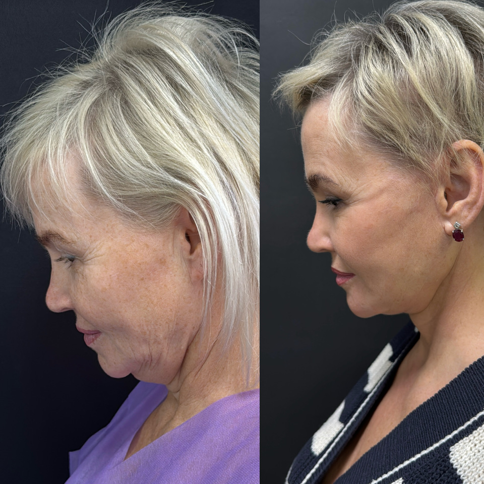Подтяжка лица и шеи . Фото до и после , фотография 4