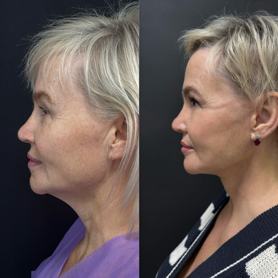 Подтяжка лица и шеи . Фото до и после , фотография 5