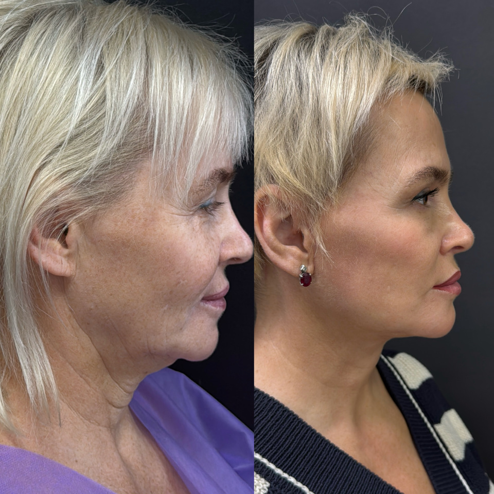 Подтяжка лица и шеи . Фото до и после , фотография 6