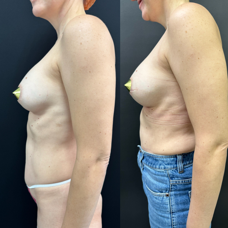 Замена имплантов . Фото до и после , фотография 3