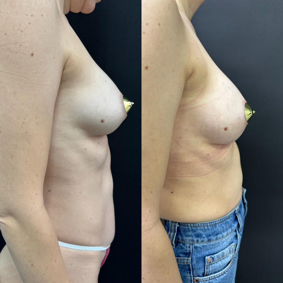 Замена имплантов . Фото до и после , фотография 5