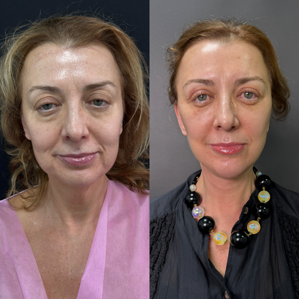 Пластика лица и шеи . Фото до после , фотография 1