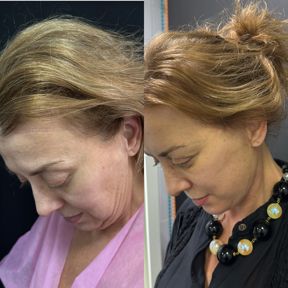 Пластика лица и шеи . Фото до после , фотография 2