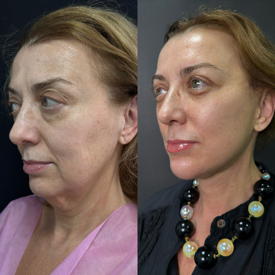 Пластика лица и шеи . Фото до после , фотография 3