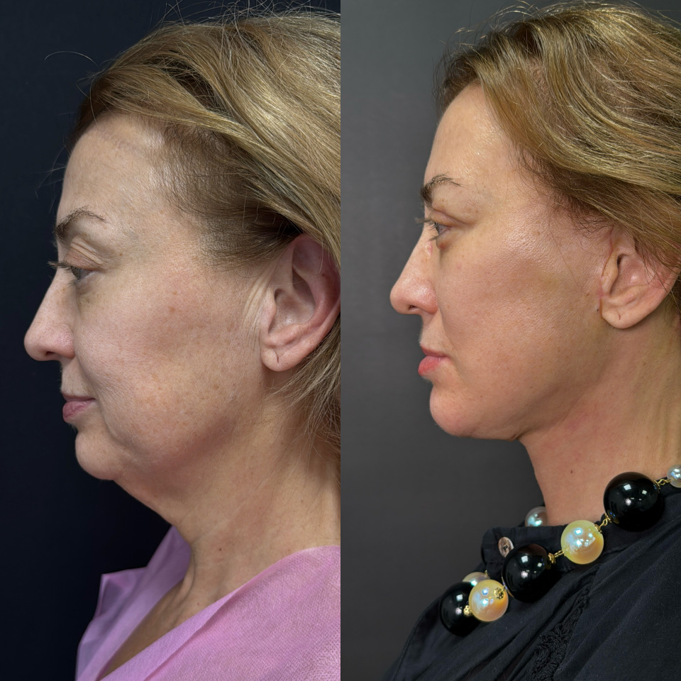 Пластика лица и шеи . Фото до после , фотография 4
