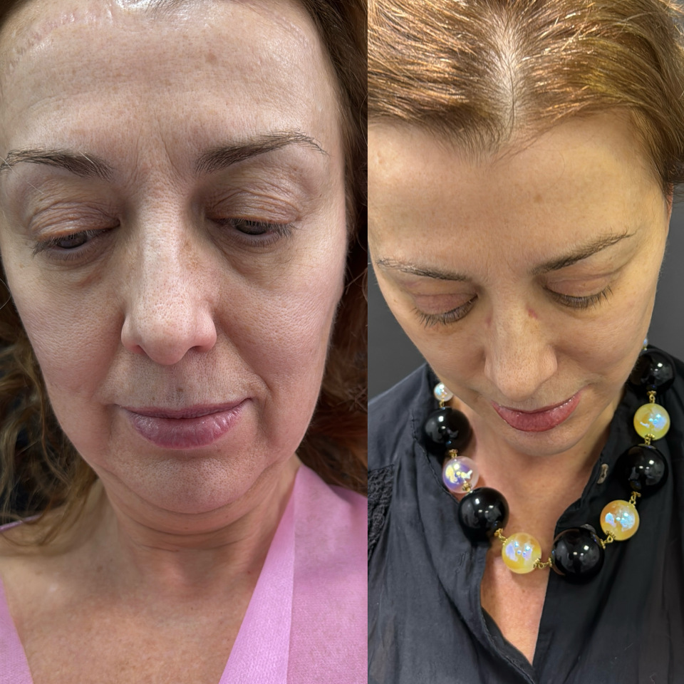 Пластика лица и шеи . Фото до после , фотография 7