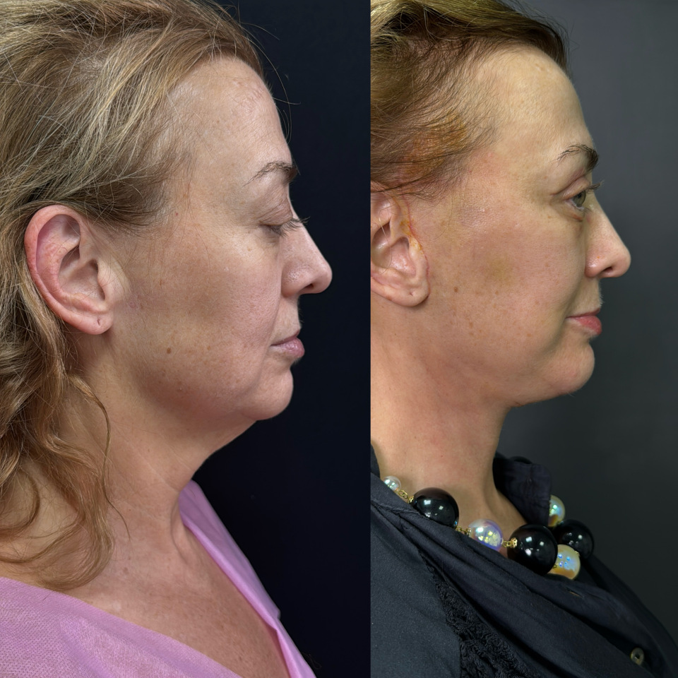Пластика лица и шеи . Фото до после , фотография 8