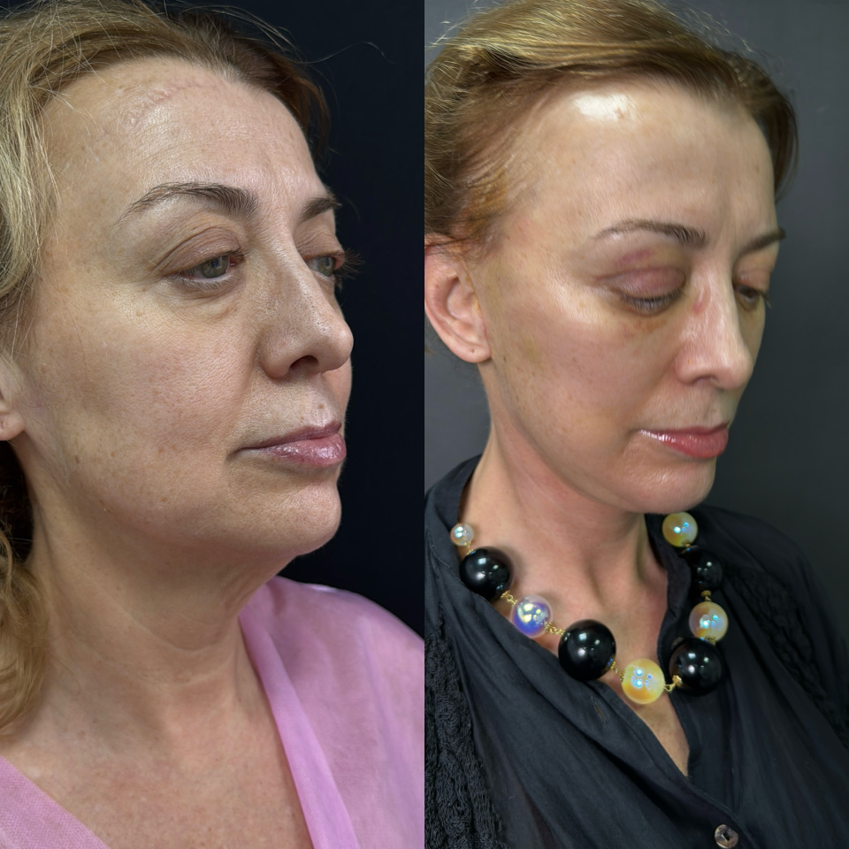 Пластика лица и шеи . Фото до после , фотография 9