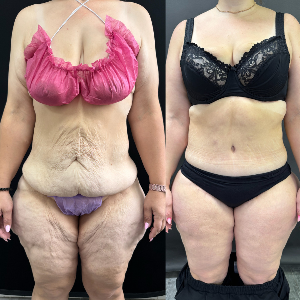 Комплексная операция . Фото до после , фотография 1