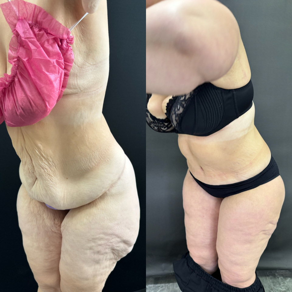 Комплексная операция . Фото до после , фотография 4