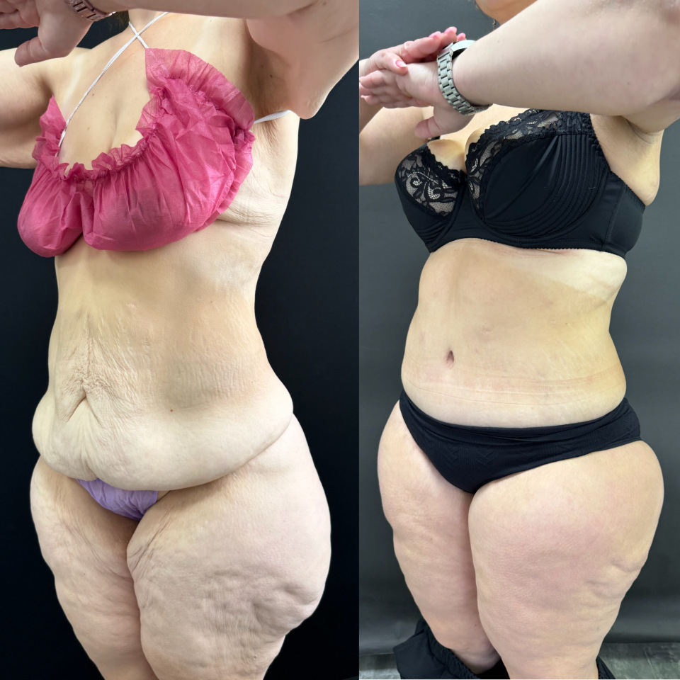 Комплексная операция . Фото до после , фотография 5