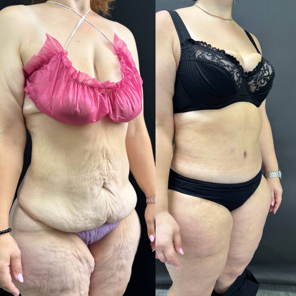 Комплексная операция . Фото до после , фотография 8