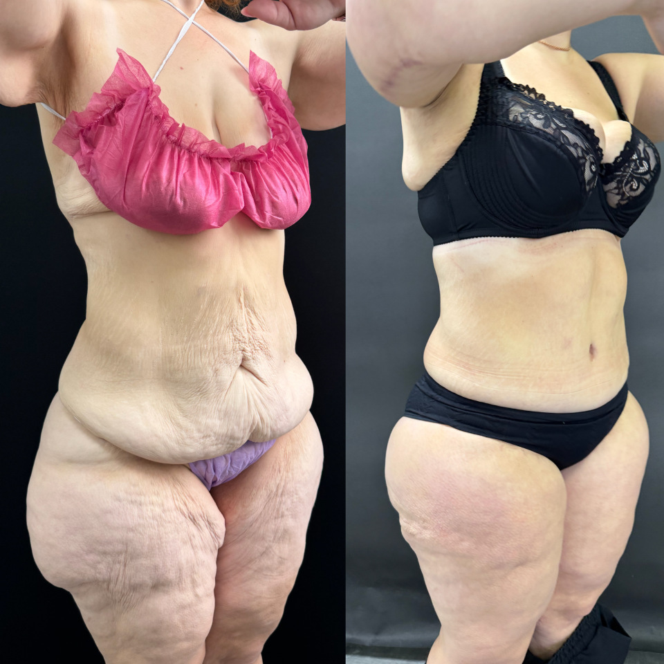 Комплексная операция . Фото до после , фотография 9