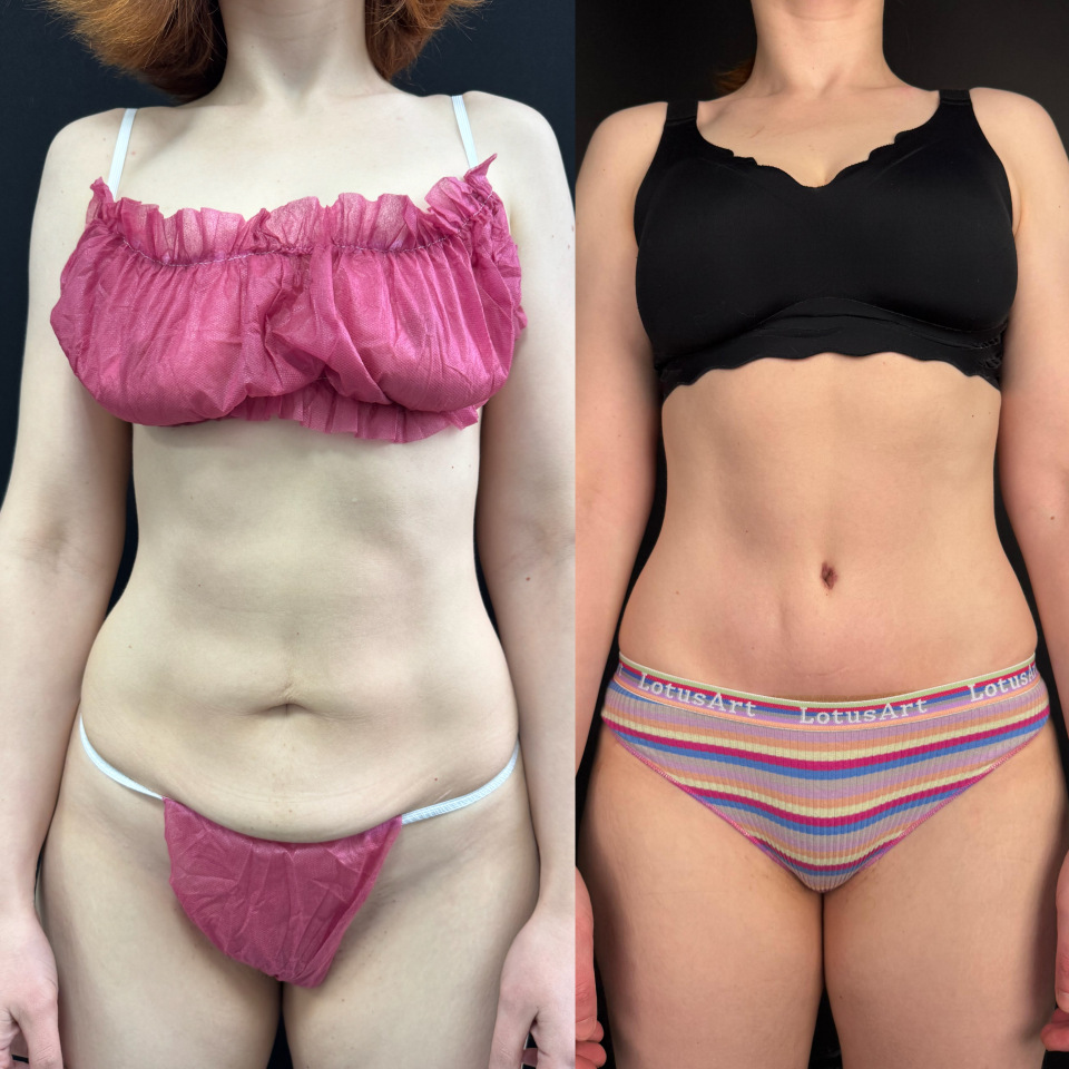 Пластика живота . Фото до после , фотография 1