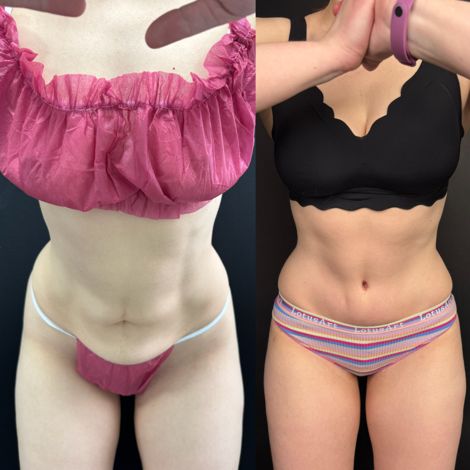 Пластика живота . Фото до после , фотография 2