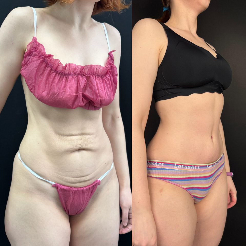 Пластика живота . Фото до после , фотография 3