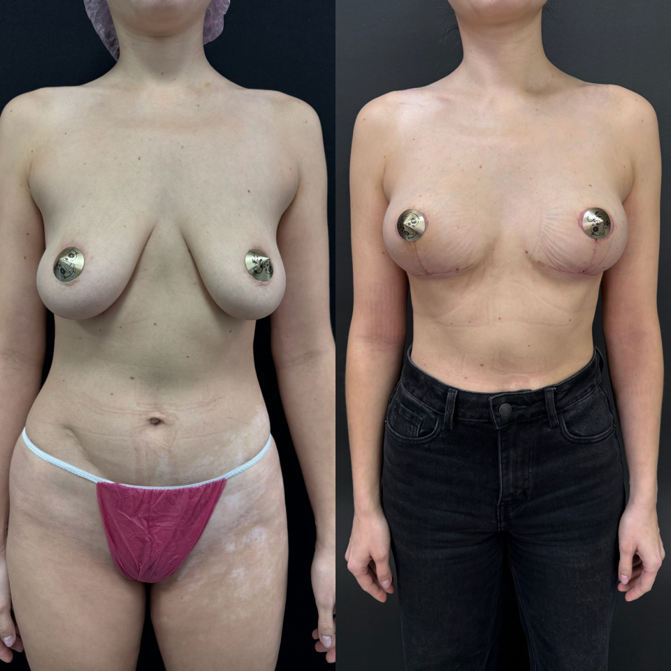 Подтяжка груди без имплантов. Фото до после , фотография 1