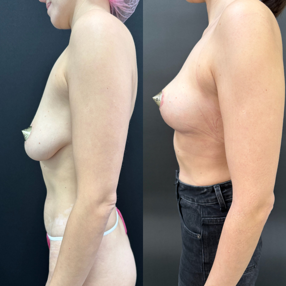 Подтяжка груди без имплантов. Фото до после , фотография 3