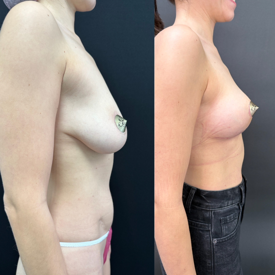 Подтяжка груди без имплантов. Фото до после , фотография 5