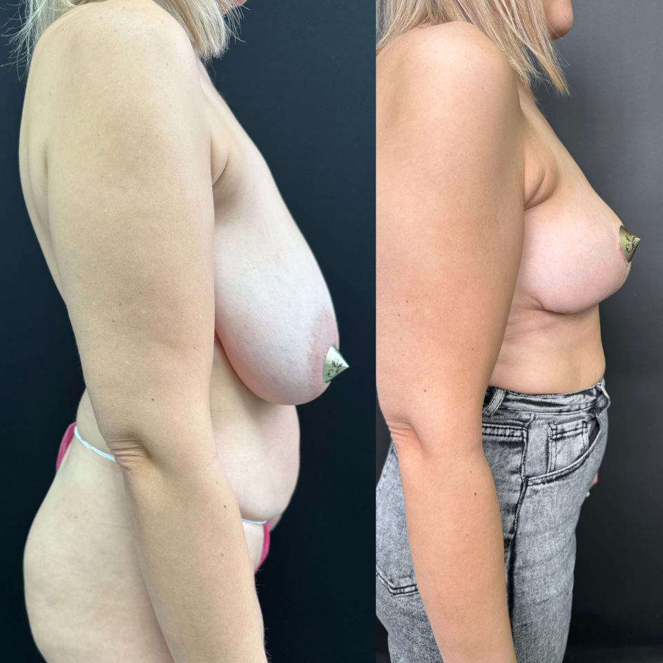 Уменьшение груди . Фото до и после , фотография 5