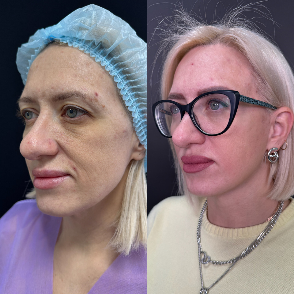Фейслифтинг . Фото до и после , фотография 1