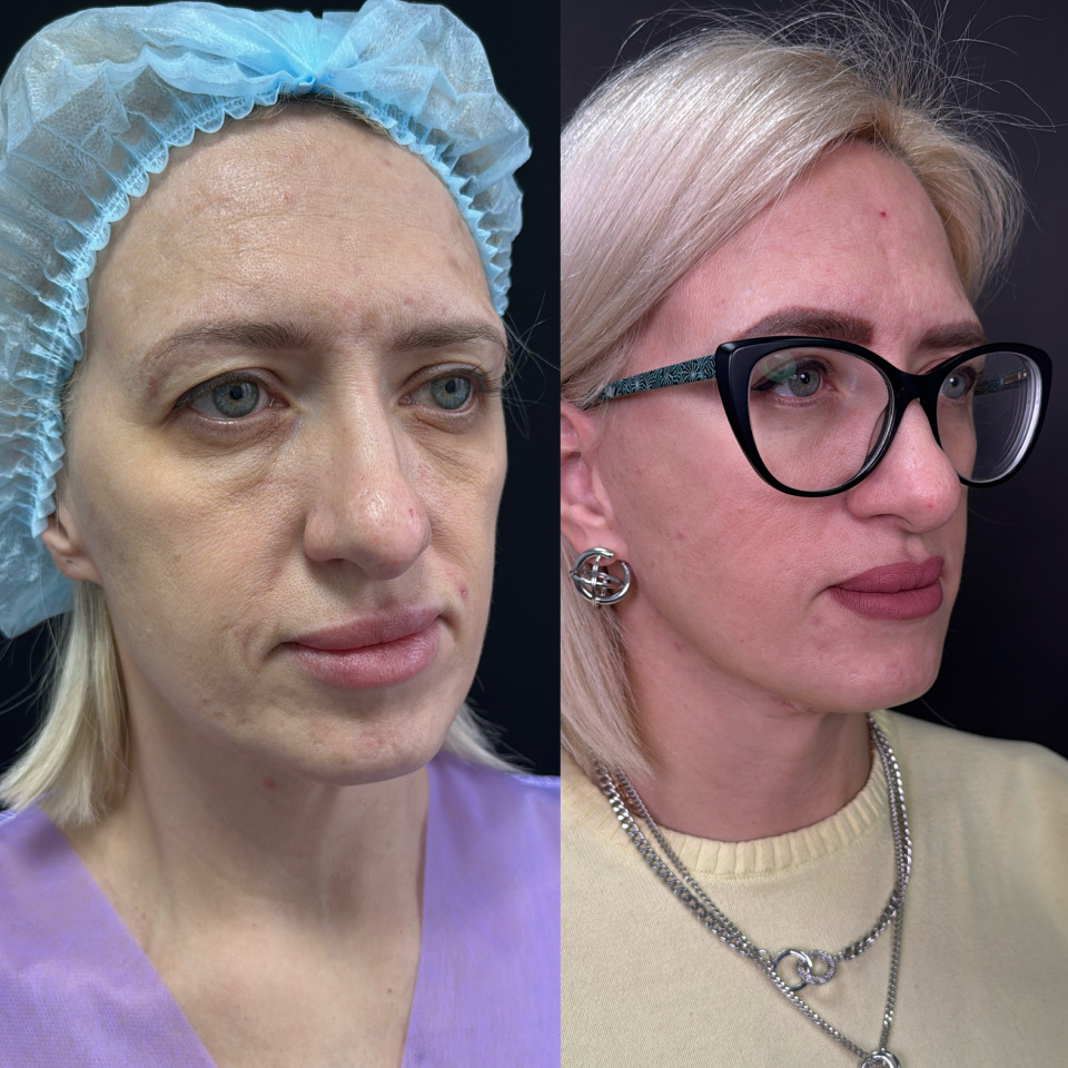 Фейслифтинг . Фото до и после , фотография 4