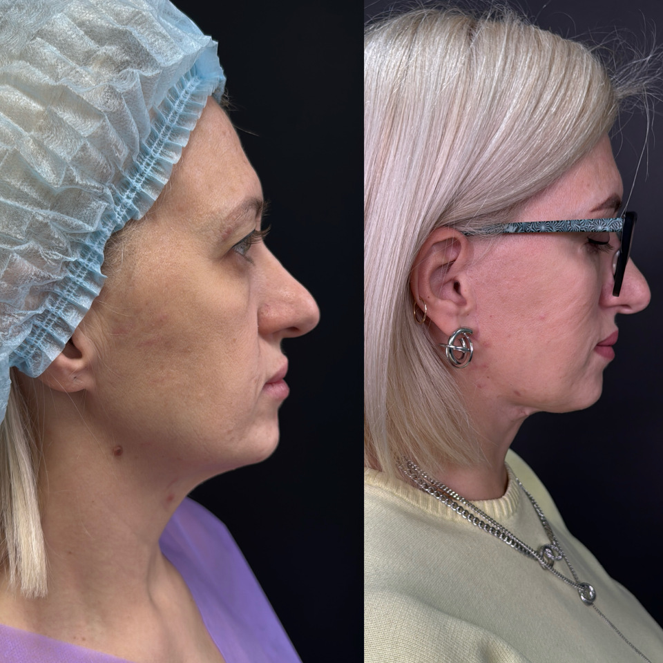 Фейслифтинг . Фото до и после , фотография 5