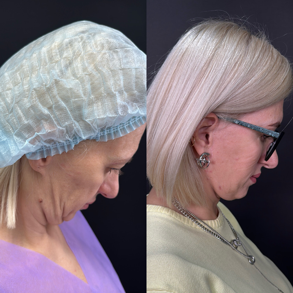 Фейслифтинг . Фото до и после , фотография 6