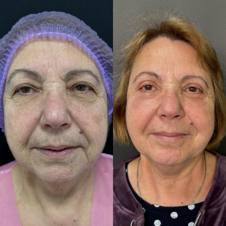 Блефаропластика верхних и нижних век . Фото до после , фотография 1