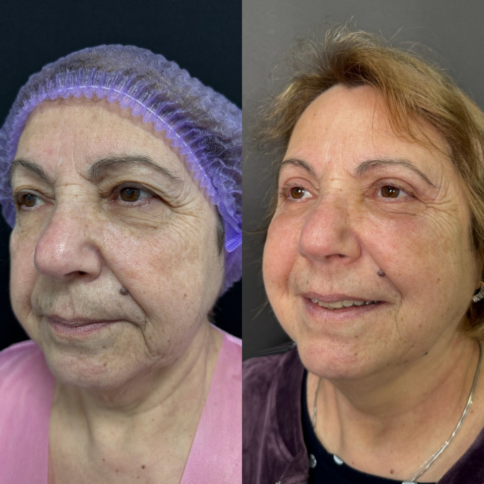 Блефаропластика верхних и нижних век . Фото до после , фотография 2