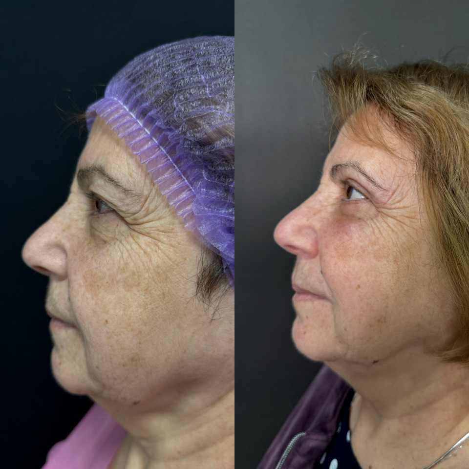 Блефаропластика верхних и нижних век . Фото до после , фотография 3