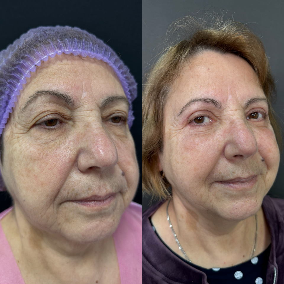 Блефаропластика верхних и нижних век . Фото до после , фотография 4