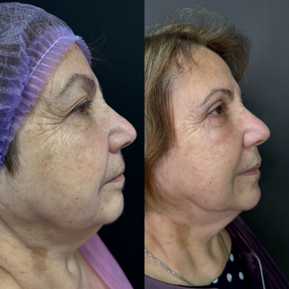 Блефаропластика верхних и нижних век . Фото до после , фотография 5